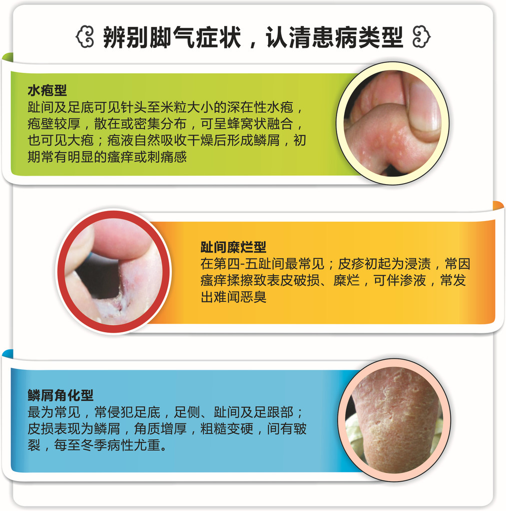 美舒芳代理加盟 沐足用品 脚气产品 脚气膏