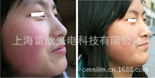 敏感性皮肤治疗前后效果对比图