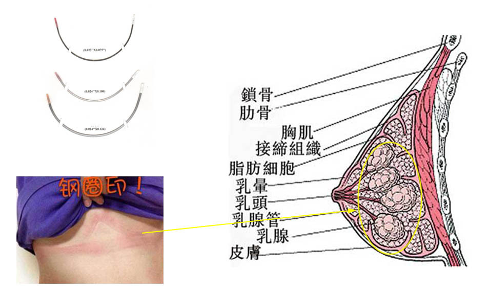 文胸到底是穿有钢圈的好还是无钢圈的好呢?听听腾飞怎么说!