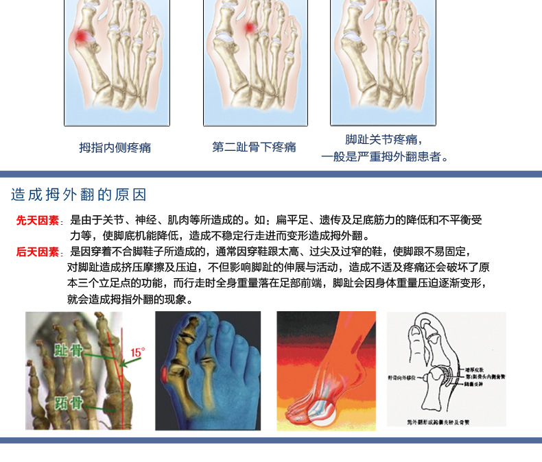 敏斯特 新品 升级版拇外翻分趾护理套 拇囊炎疼痛 大脚骨分趾垫
